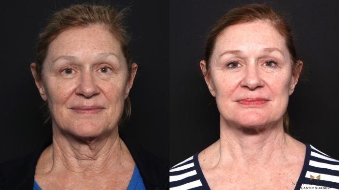 Before & After Deep Plane Facelift Case 666 Front View in Fort Worth & Arlington, Texas