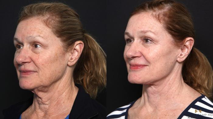 Before & After Deep Plane Facelift Case 666 Left Oblique View in Fort Worth & Arlington, Texas