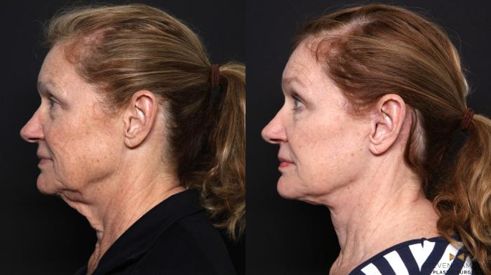 Before & After Deep Plane Facelift Case 666 Left Side View in Fort Worth & Arlington, Texas