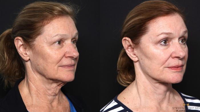 Before & After Deep Plane Facelift Case 666 Right Oblique View in Fort Worth & Arlington, Texas