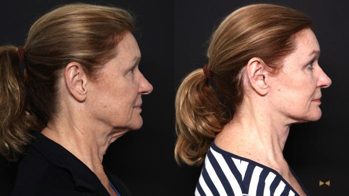 Before & After Deep Plane Facelift Case 666 Right Side View in Fort Worth & Arlington, Texas