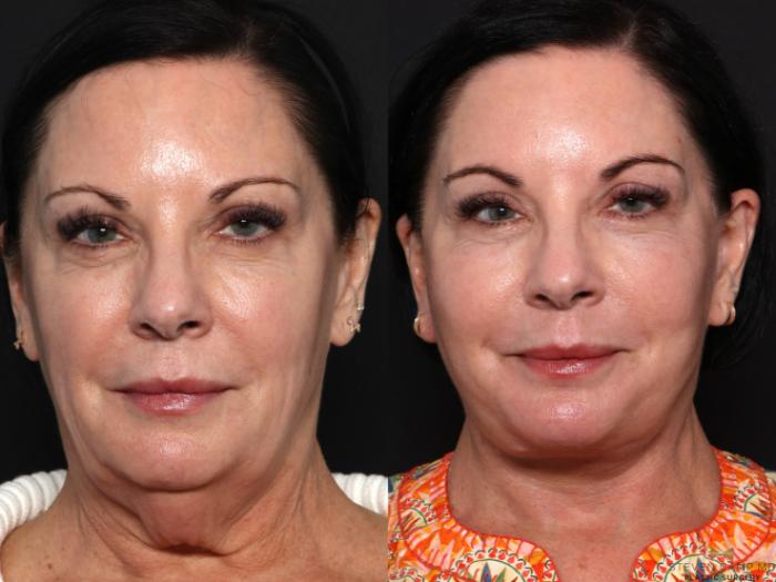 Before & After Deep Plane Facelift Case 681 Front View in Fort Worth & Arlington, Texas