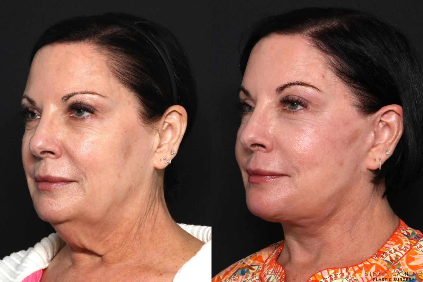 Before & After Deep Plane Facelift Case 681 Left Oblique View in Fort Worth & Arlington, Texas