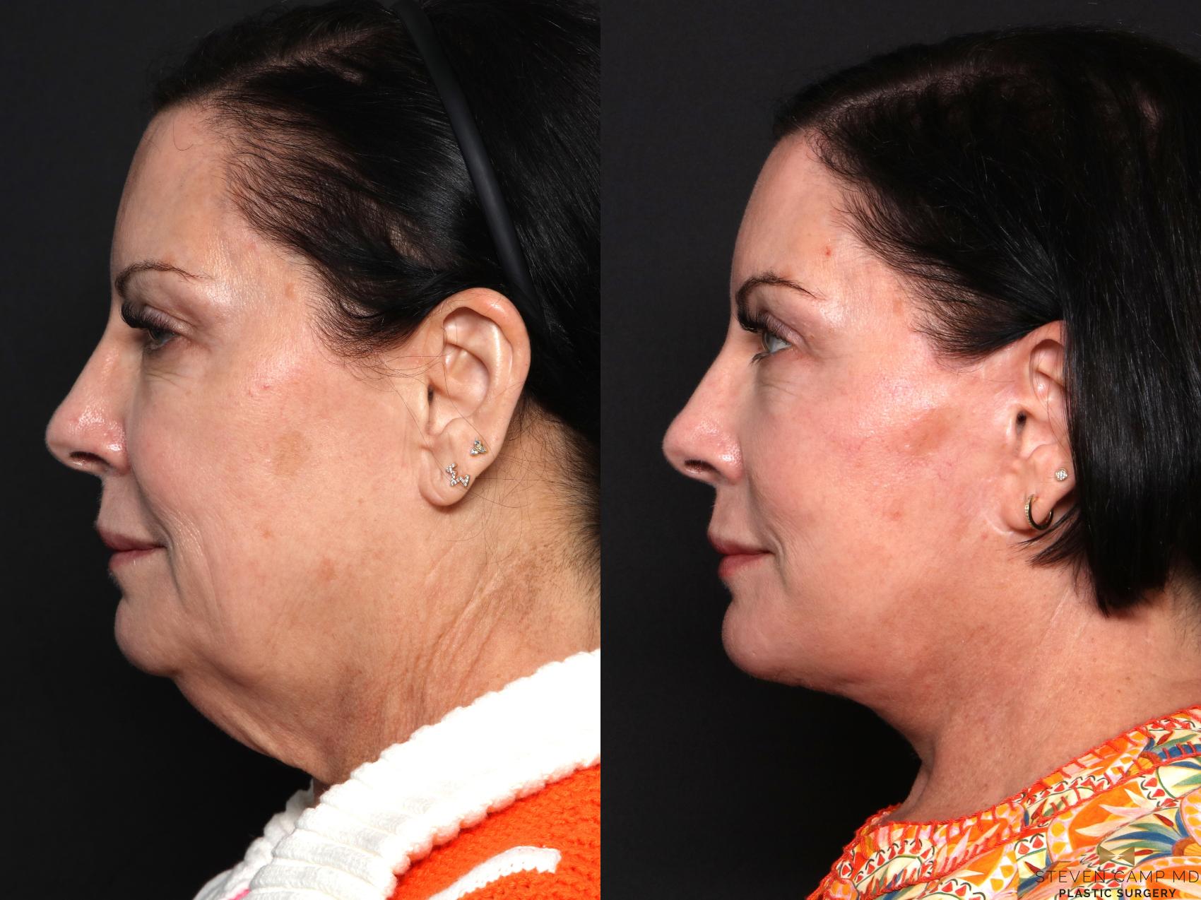 Before & After BOTOX Case 681 Left Side View in Fort Worth & Arlington, Texas