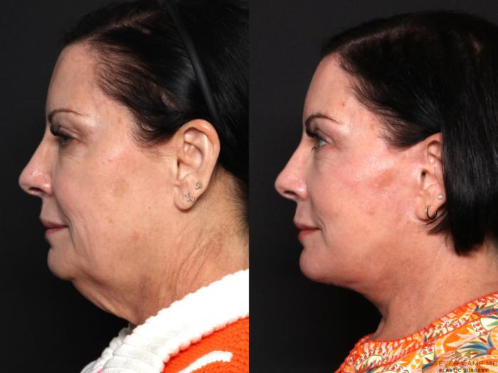 Before & After Deep Plane Facelift Case 681 Left Side View in Fort Worth & Arlington, Texas