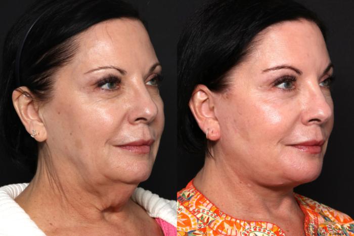 Before & After Deep Plane Facelift Case 681 Right Oblique View in Fort Worth & Arlington, Texas