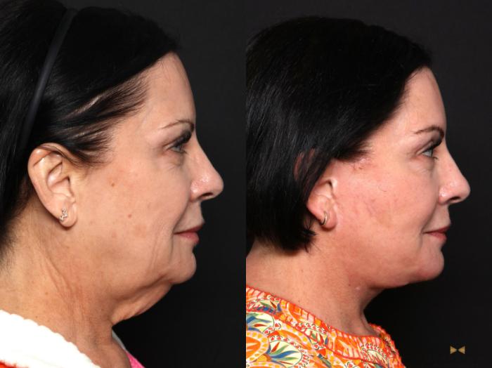 Before & After Deep Plane Facelift Case 681 Right Side View in Fort Worth & Arlington, Texas