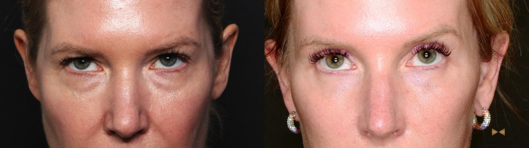 Before & After Deep Plane Facelift Case 687 Close up bleph view View in Fort Worth & Arlington, Texas