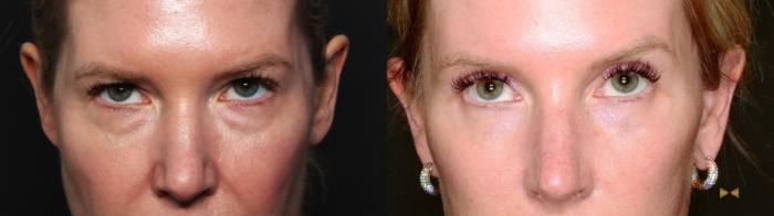 Before & After Deep Plane Facelift Case 687 Close up bleph view View in Fort Worth & Arlington, Texas