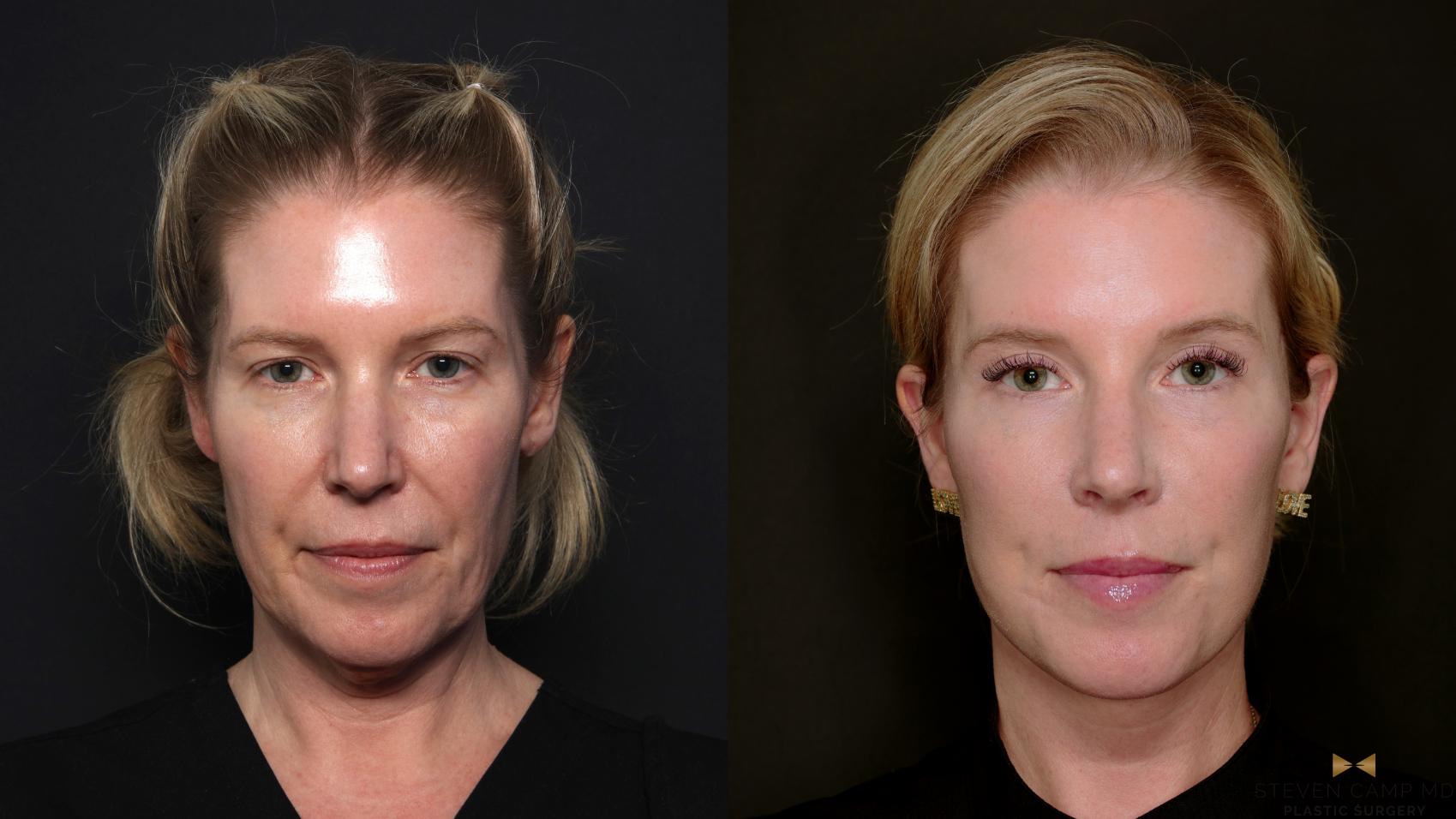 Before & After Deep Plane Facelift Case 687 Front View in Fort Worth & Arlington, Texas