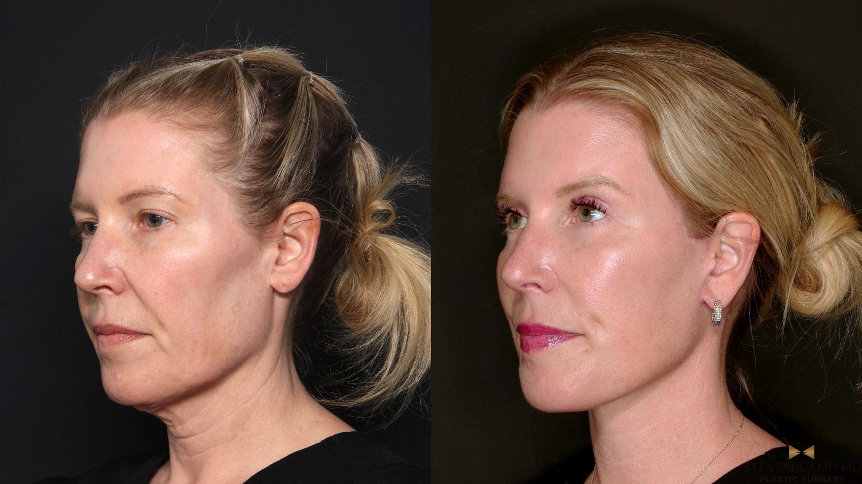 Before & After Deep Plane Facelift Case 687 Left Oblique View in Fort Worth & Arlington, Texas