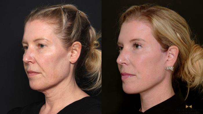 Before & After Deep Plane Facelift Case 687 Left Oblique View in Fort Worth & Arlington, Texas