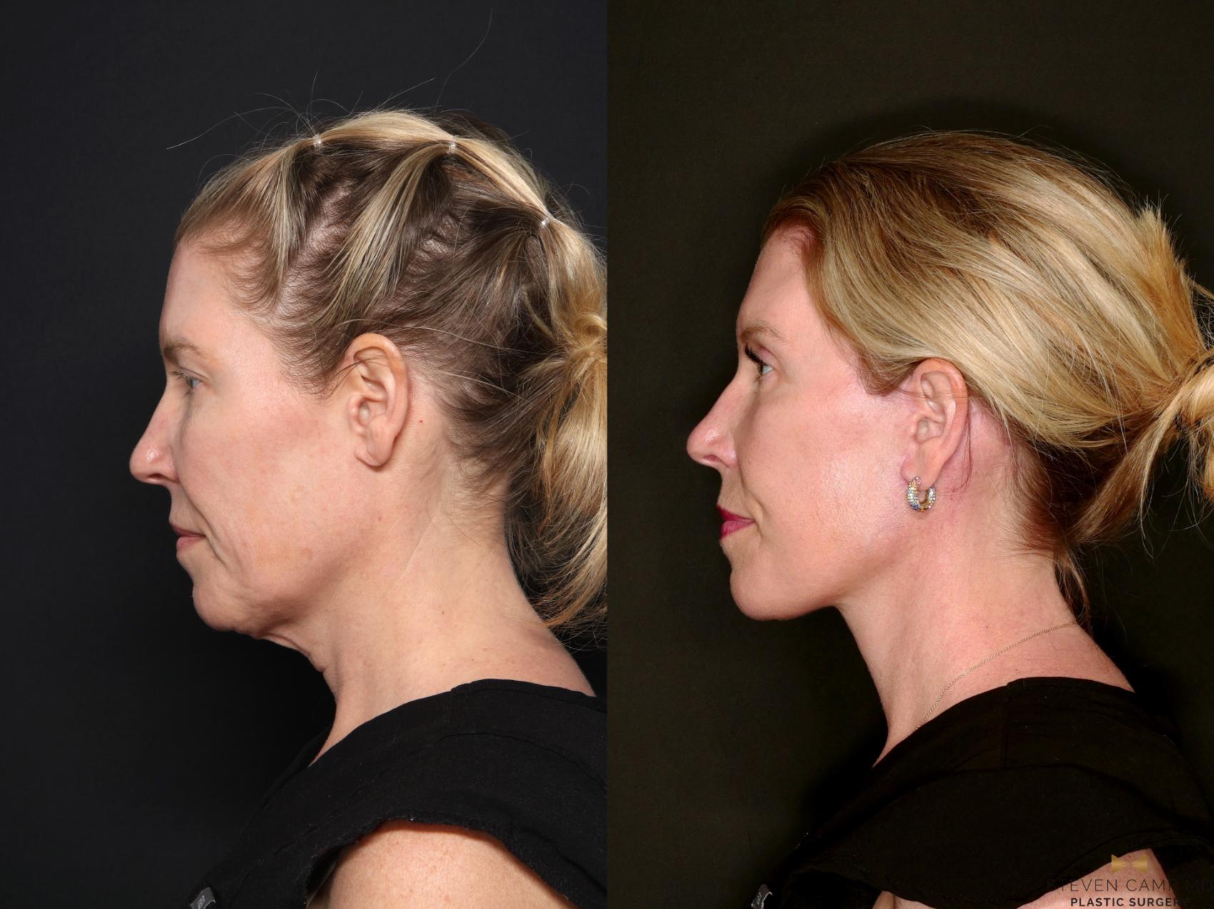 Before & After Deep Plane Facelift Case 687 Left Side View in Fort Worth & Arlington, Texas