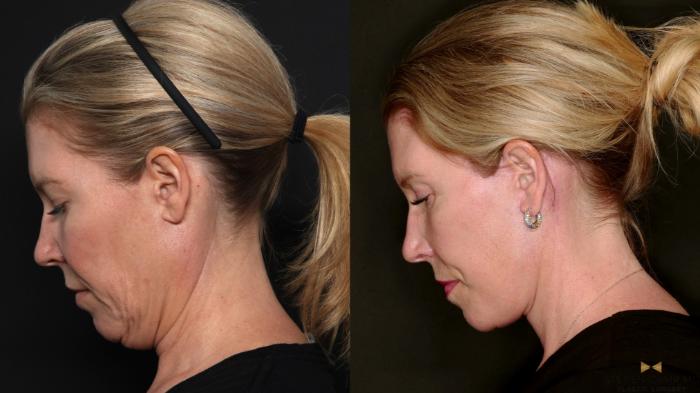 Before & After Deep Plane Facelift Case 687 Left side looking down View in Fort Worth & Arlington, Texas