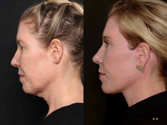 Before & After Deep Plane Facelift Case 687 Left Side View in Fort Worth & Arlington, Texas