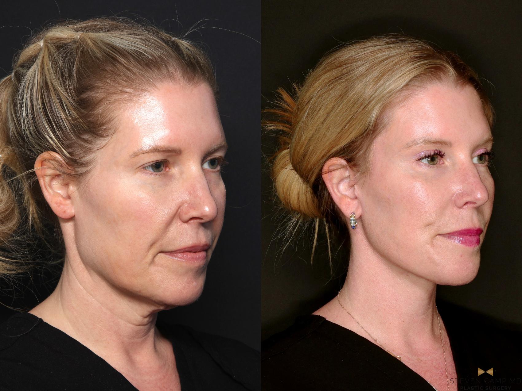 Before & After Deep Plane Facelift Case 687 Right Oblique View in Fort Worth & Arlington, Texas