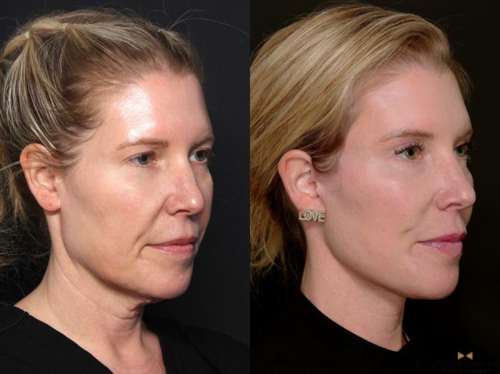 Before & After Deep Plane Facelift Case 687 Right Oblique View in Fort Worth & Arlington, Texas