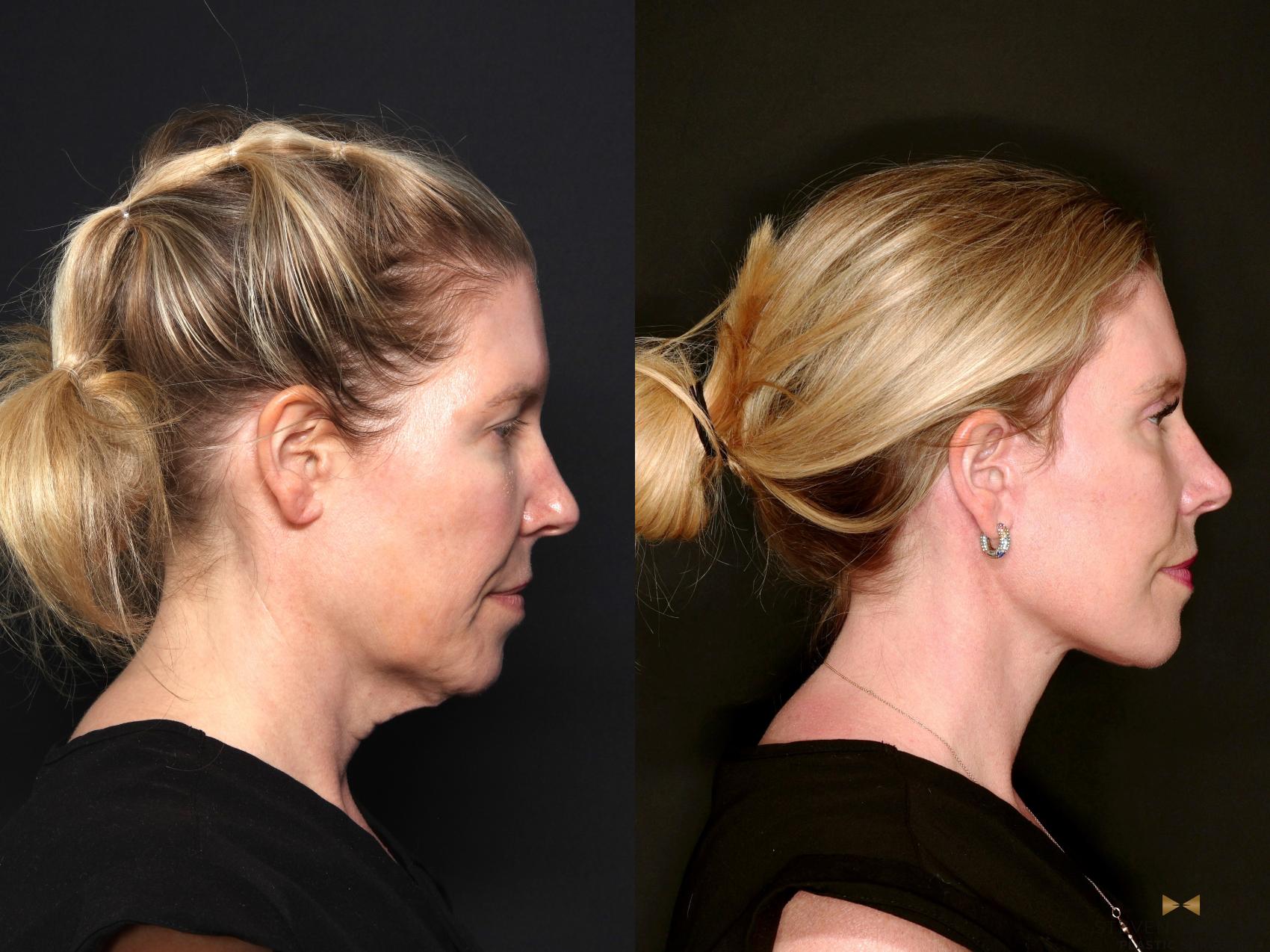 Before & After Deep Plane Facelift Case 687 Right Side View in Fort Worth & Arlington, Texas