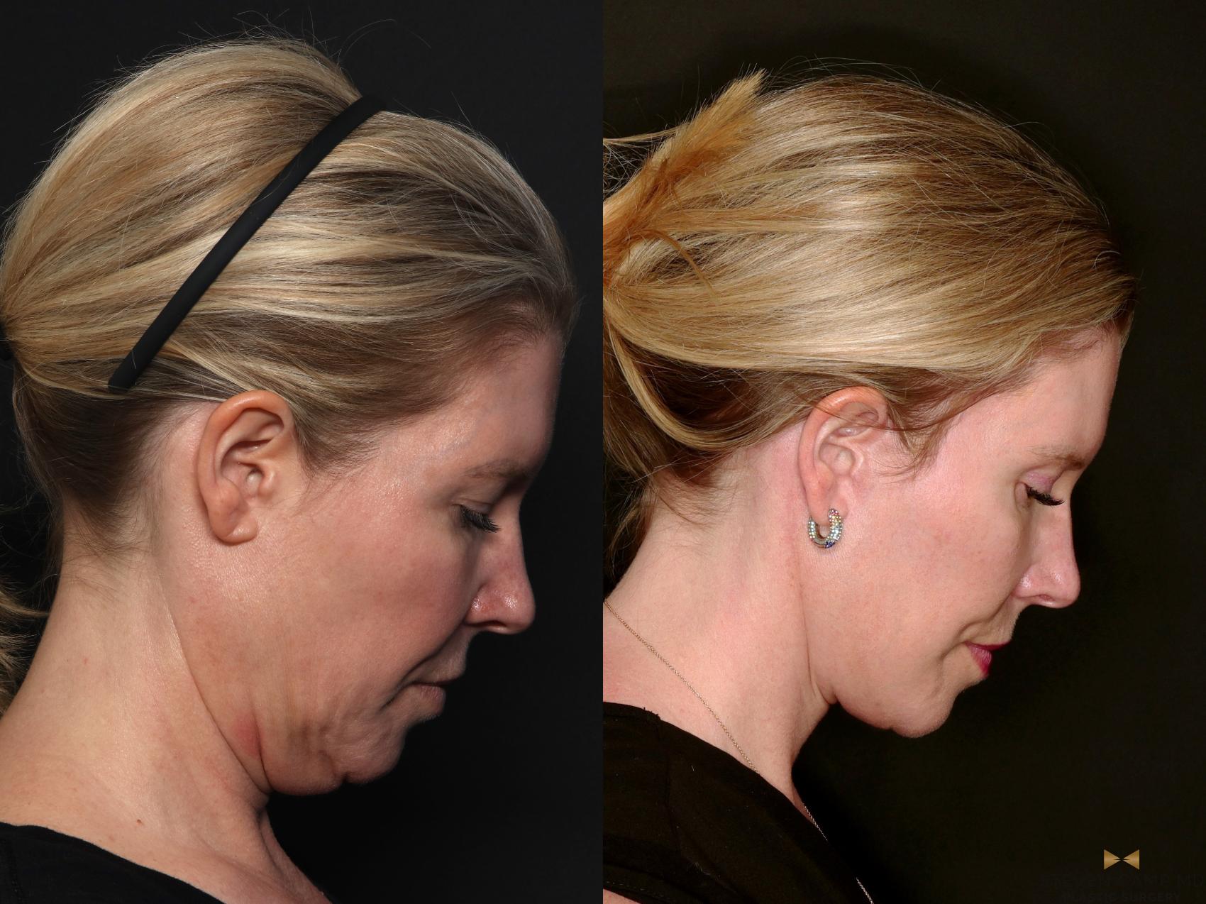 Before & After Deep Plane Facelift Case 687 Right side looking down View in Fort Worth & Arlington, Texas