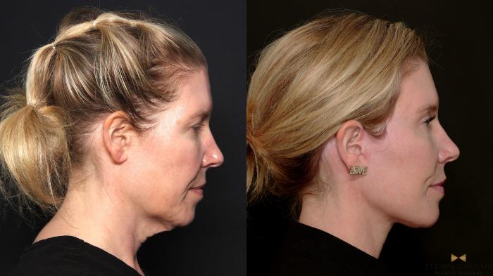 Before & After Deep Plane Facelift Case 687 Right Side View in Fort Worth & Arlington, Texas