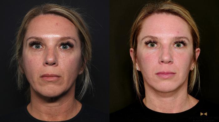 Before & After Deep Plane Facelift Case 699 Front View in Fort Worth & Arlington, Texas