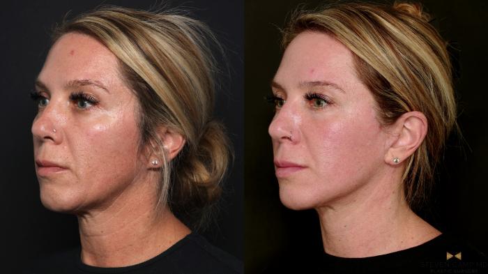 Before & After Deep Plane Facelift Case 699 Left Oblique View in Fort Worth & Arlington, Texas