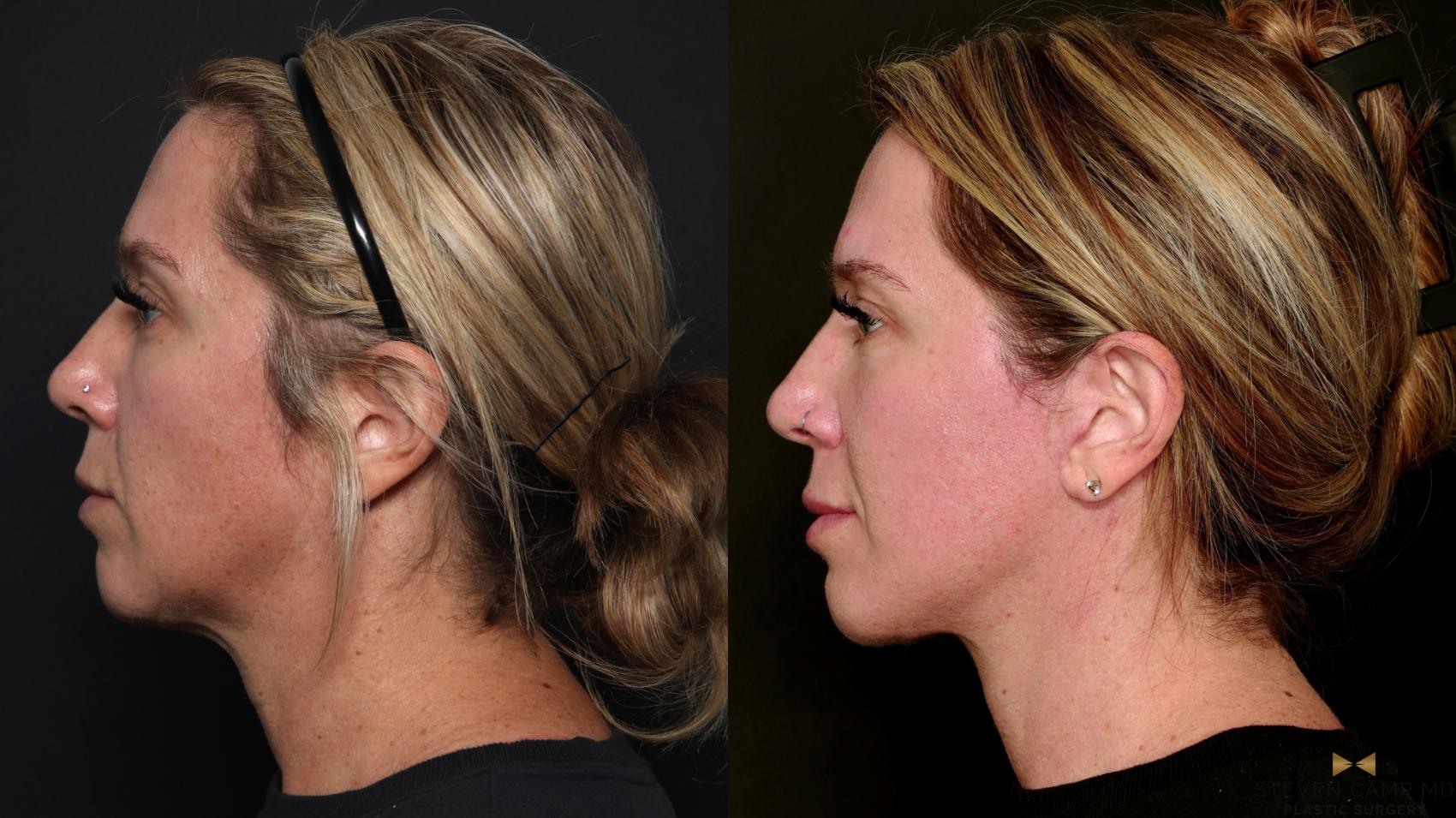 Before & After Deep Plane Facelift Case 699 Left Side View in Fort Worth & Arlington, Texas