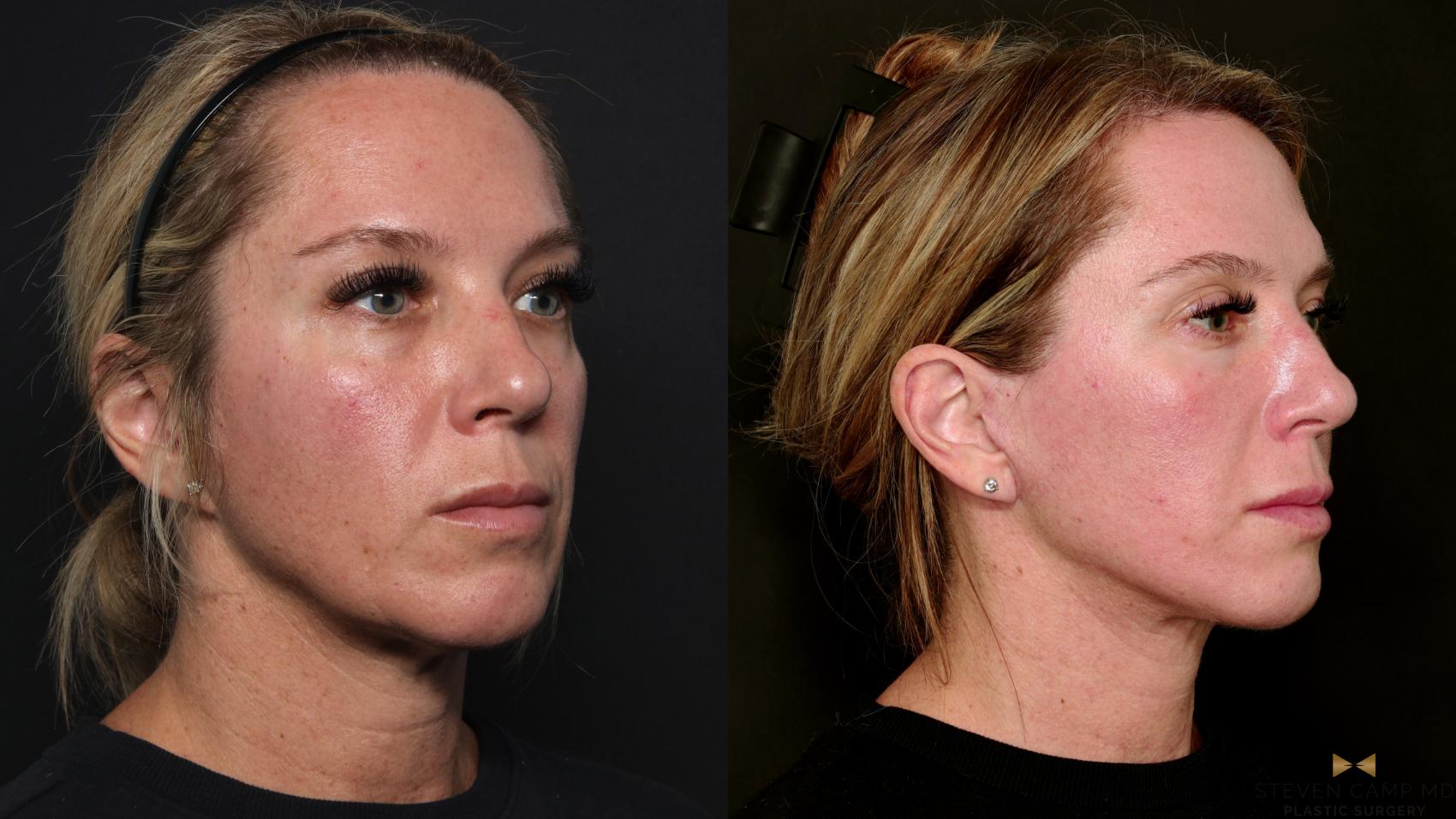 Before & After Deep Plane Facelift Case 699 Right Oblique View in Fort Worth & Arlington, Texas