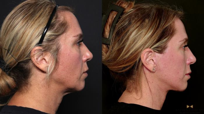 Before & After Deep Plane Facelift Case 699 Right Side View in Fort Worth & Arlington, Texas