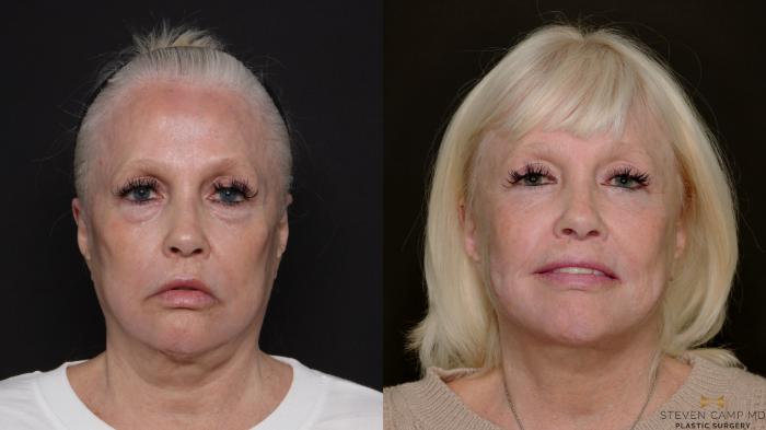 Before & After Deep Plane Facelift Case 700 Front View in Fort Worth & Arlington, Texas