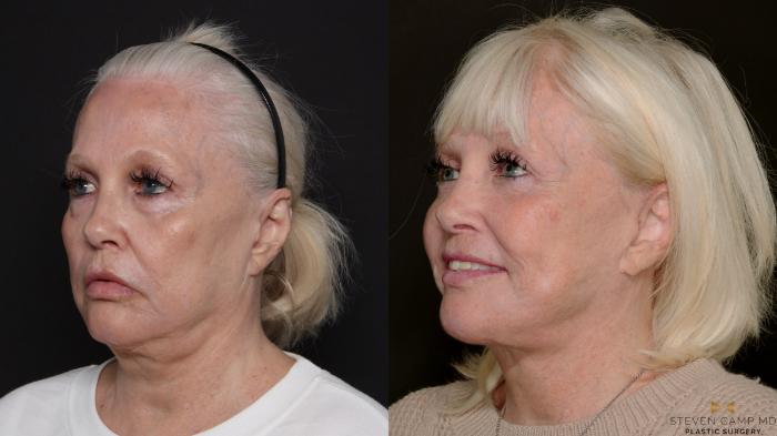 Before & After Deep Plane Facelift Case 700 Left Oblique View in Fort Worth & Arlington, Texas