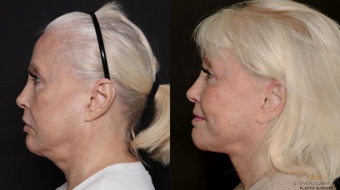 Before & After Deep Plane Facelift Case 700 Left Side View in Fort Worth & Arlington, Texas