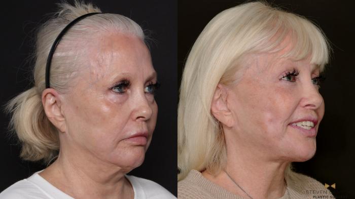 Before & After Deep Plane Facelift Case 700 Right Oblique View in Fort Worth & Arlington, Texas