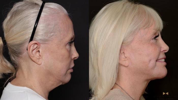 Before & After Deep Plane Facelift Case 700 Right Side View in Fort Worth & Arlington, Texas