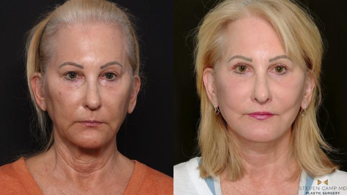 Before & After Deep Plane Facelift Case 701 Front View in Fort Worth & Arlington, Texas