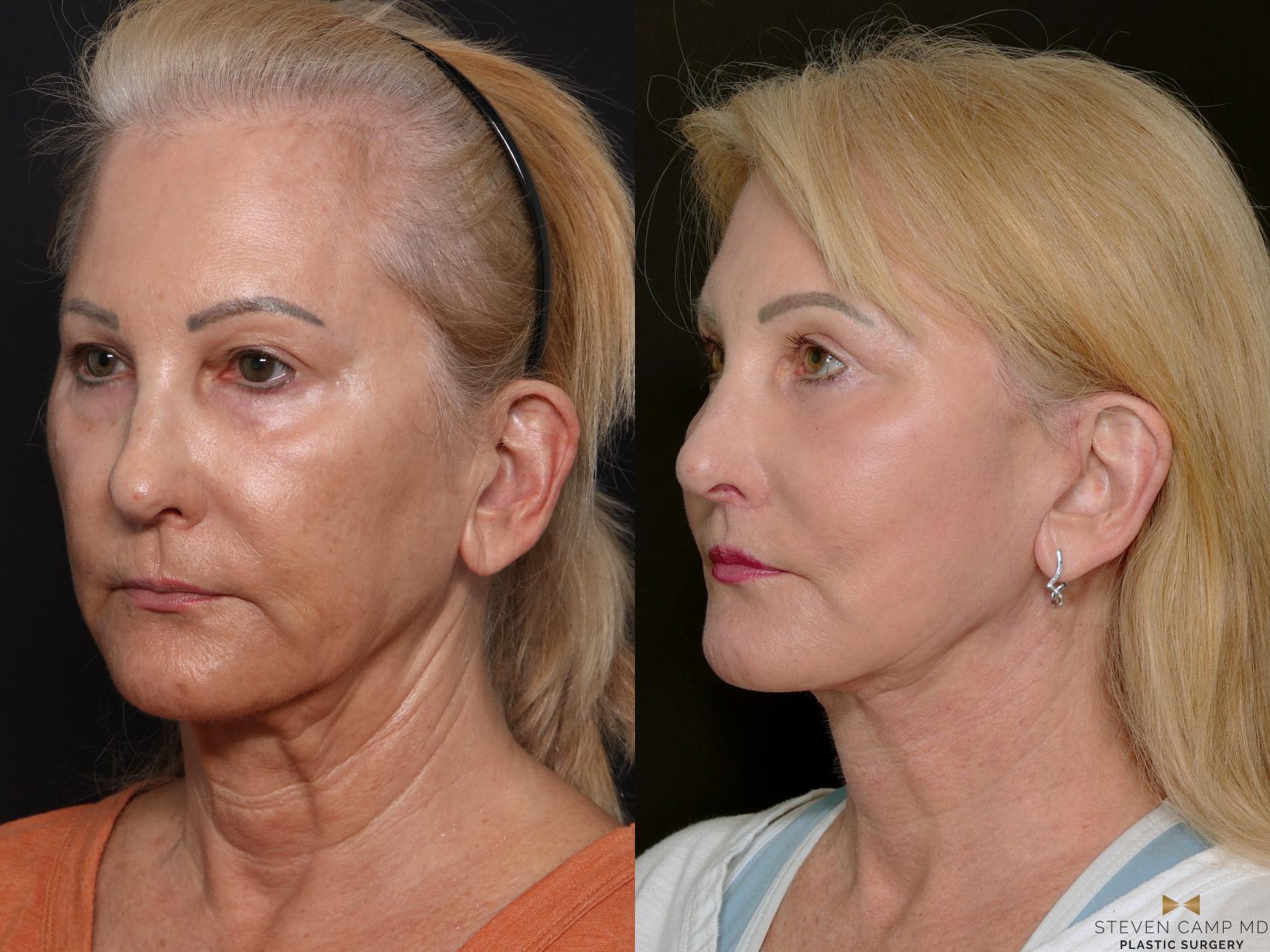 Before & After Sciton Laser Case 701 Left Oblique View in Fort Worth & Arlington, Texas