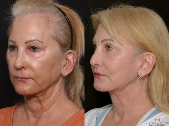 Before & After Deep Plane Facelift Case 701 Left Oblique View in Fort Worth & Arlington, Texas