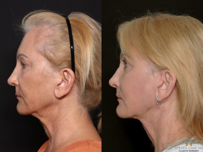 Before & After Deep Plane Facelift Case 701 Left Side View in Fort Worth & Arlington, Texas