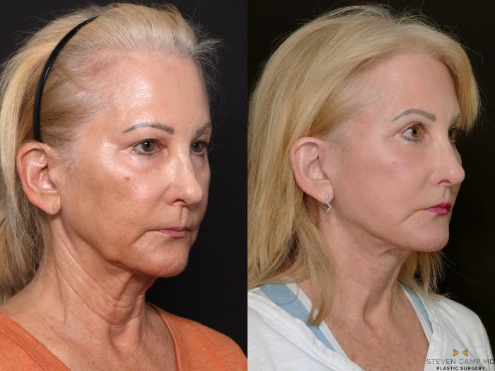 Before & After Deep Plane Facelift Case 701 Right Oblique View in Fort Worth & Arlington, Texas