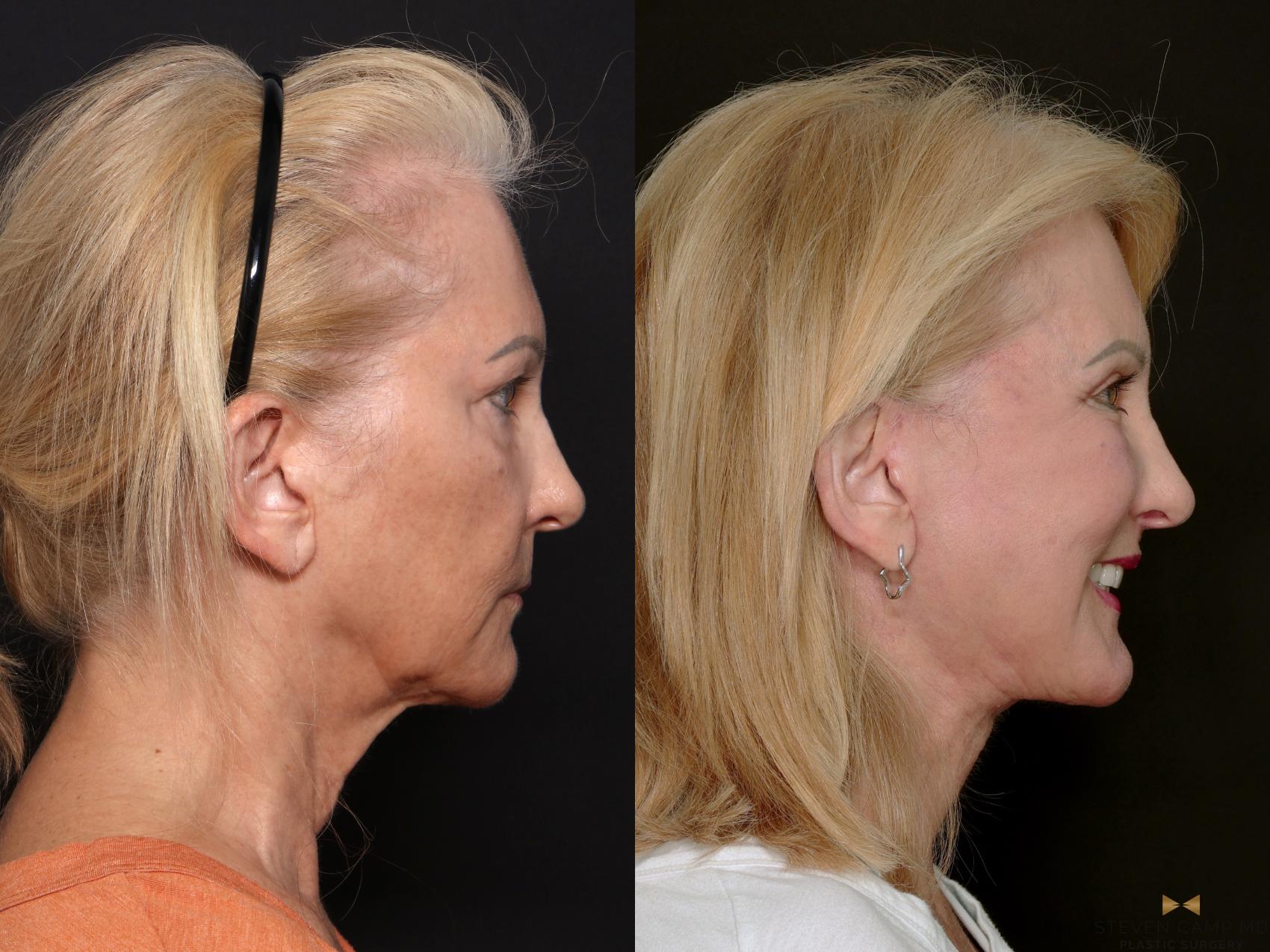 Before & After Deep Plane Facelift Case 701 Right Side View in Fort Worth & Arlington, Texas