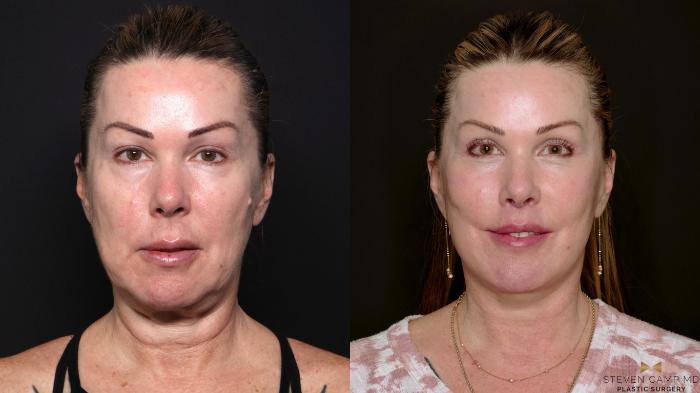 Before & After Deep Plane Facelift Case 702 Front View in Fort Worth & Arlington, Texas