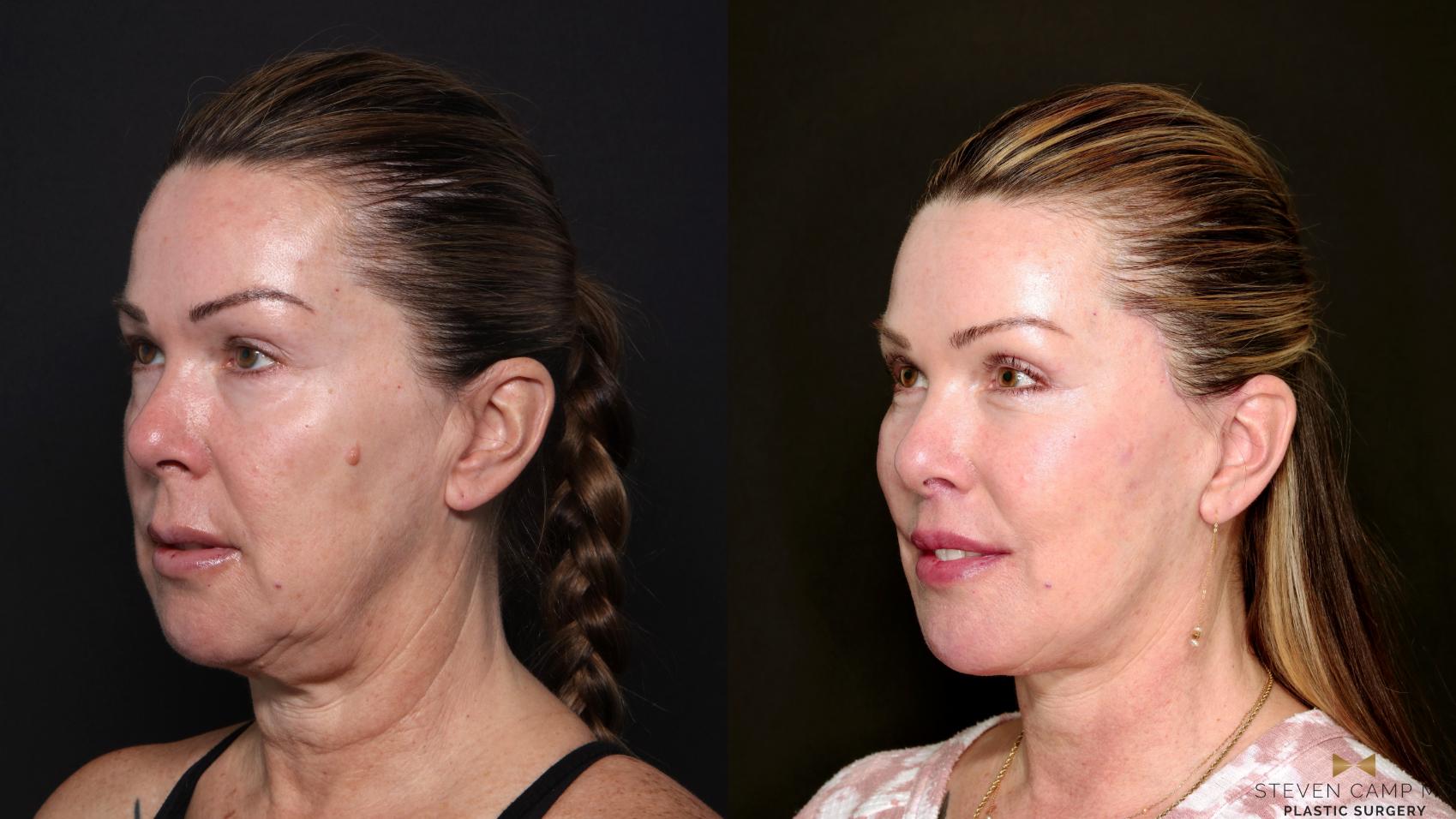 Before & After Deep Plane Facelift Case 702 Left Oblique View in Fort Worth & Arlington, Texas