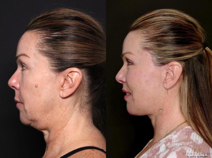 Before & After Deep Plane Facelift Case 702 Left Side View in Fort Worth & Arlington, Texas