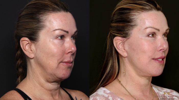 Before & After Deep Plane Facelift Case 702 Right Oblique View in Fort Worth & Arlington, Texas