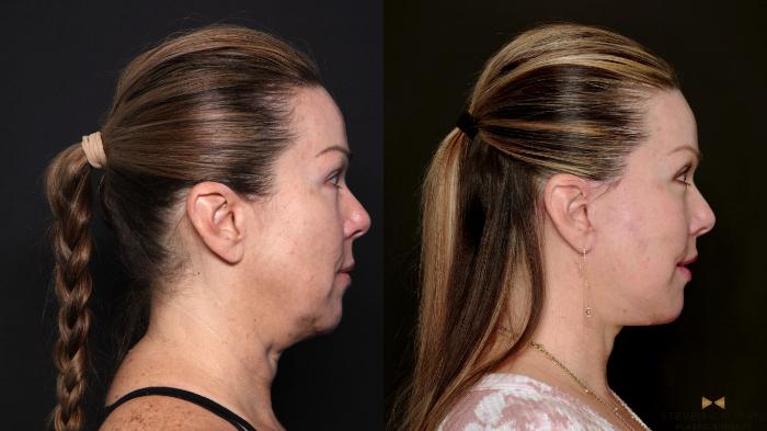 Before & After Deep Plane Facelift Case 702 Right Side View in Fort Worth & Arlington, Texas