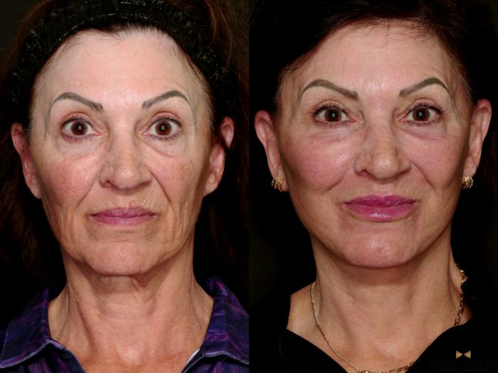Before & After Facial Fat Grafting Case 712 Front View in Fort Worth & Arlington, Texas