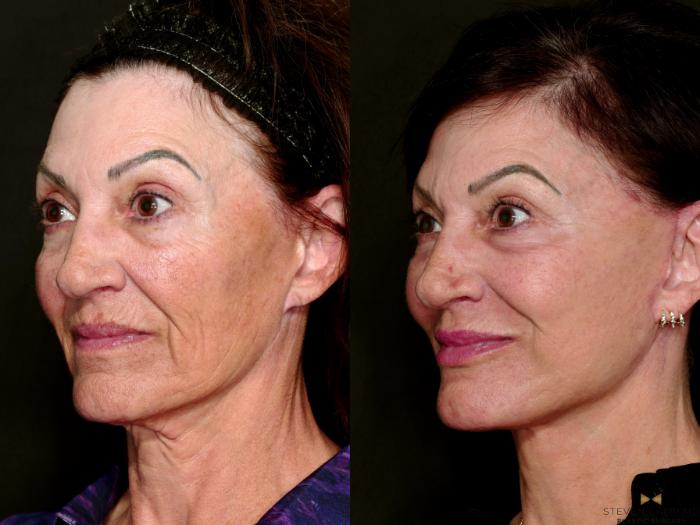 Before & After Facial Fat Grafting Case 712 Left Oblique View in Fort Worth & Arlington, Texas