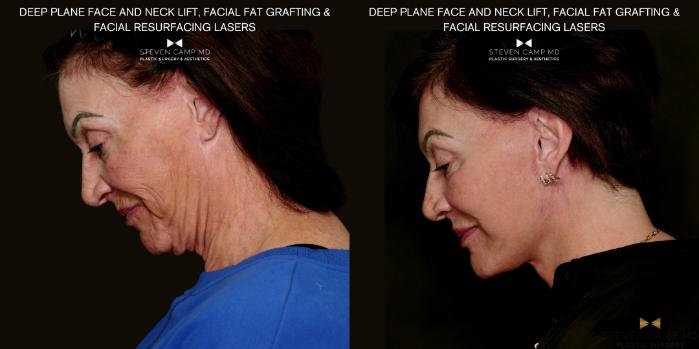 Before & After Deep Plane Facelift Case 712 Left Side View in Fort Worth & Arlington, Texas