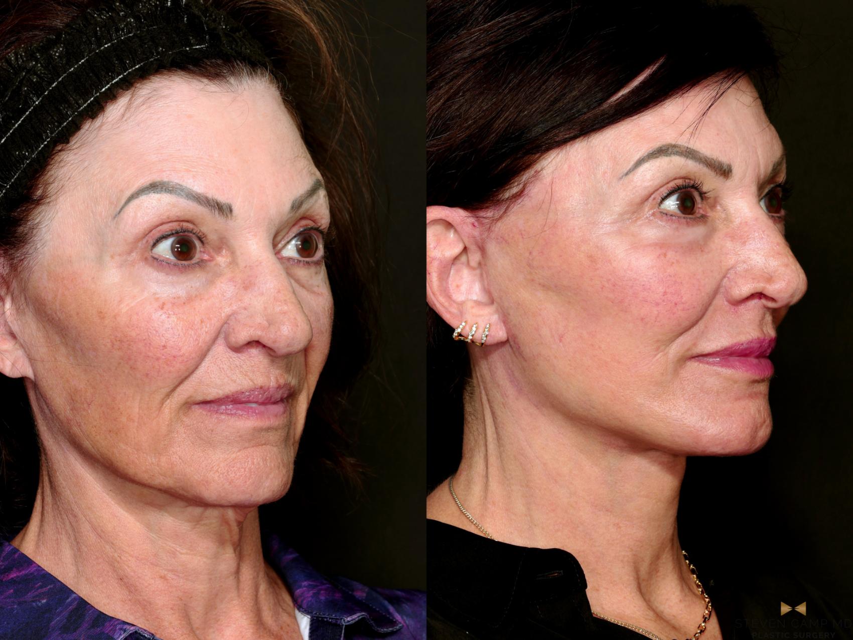 Before & After Deep Plane Facelift Case 712 Right Oblique View in Fort Worth & Arlington, Texas