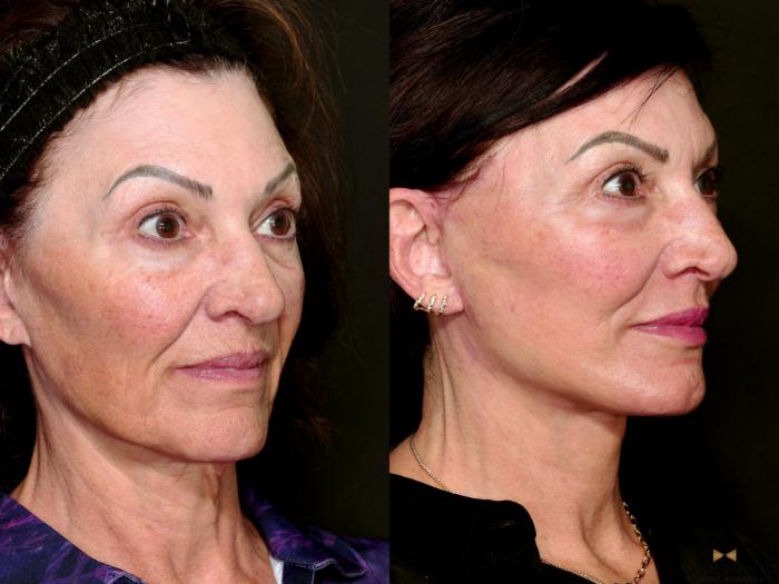 Before & After Facial Fat Grafting Case 712 Right Oblique View in Fort Worth & Arlington, Texas